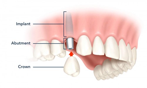 Bảng Giá Trồng Răng Implant Thủ Đức | Không Đau, Đẹp, Uy Tín