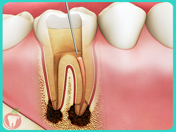 Điều trị tuỷ răng Nha Khoa LINH XUÂN