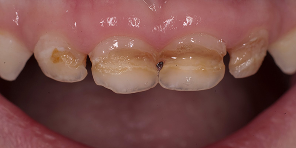 Sâu răng hàng loạt trên các răng cửa cần có biện pháp phòng ngừa như vecni fluoride