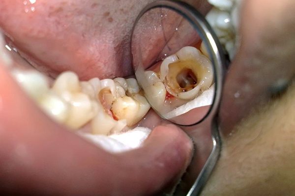 Điều trị tủy răng