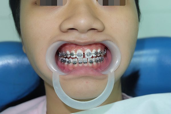 niềng răng thưa