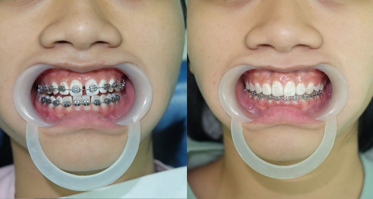 Niềng răng thưa kẽ