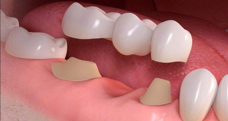 Trồng răng bắc cầu sứ
