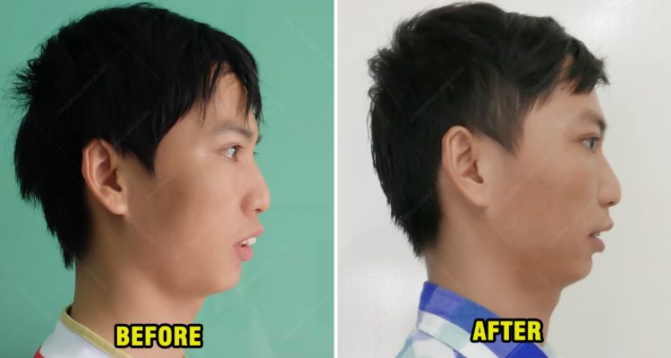 Niềng răng hô