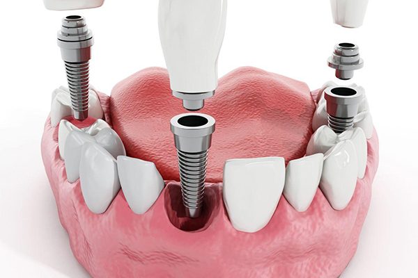 Cấy ghép răng Implant