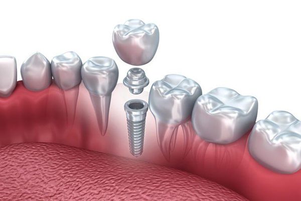 Cấy ghép răng Implant