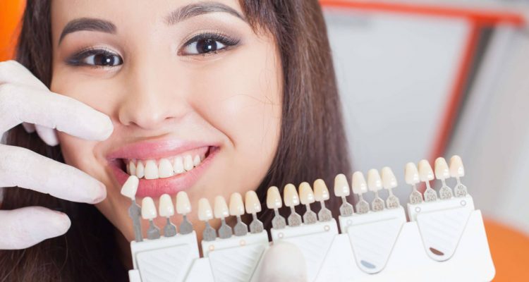 Dán sứ Veneer