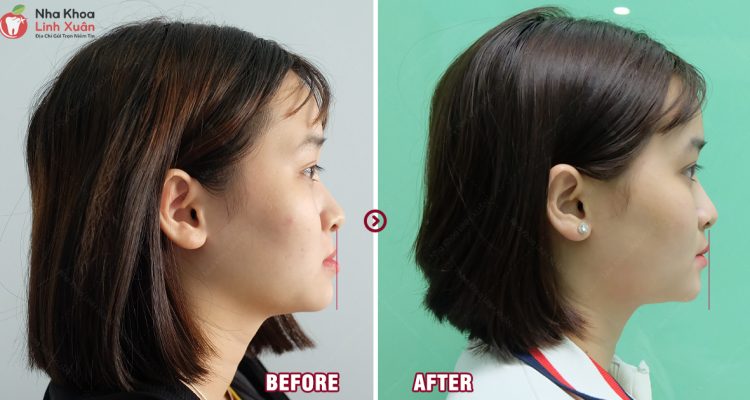 Kinh nghiệm niềng răng móm