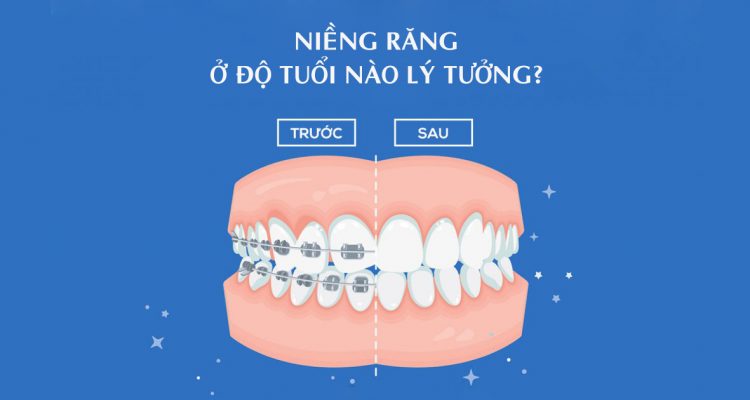Nên niềng răng ở độ tuổi nào