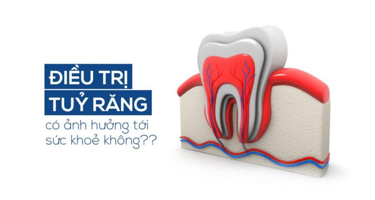 Điều trị tuỷ răng có ảnh hưởng tới sức khoẻ không