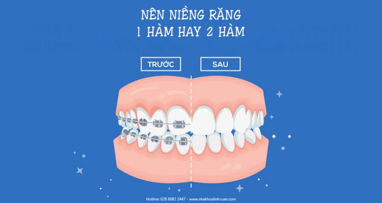 Nên niềng răng 1 hàm hay 2 hàm