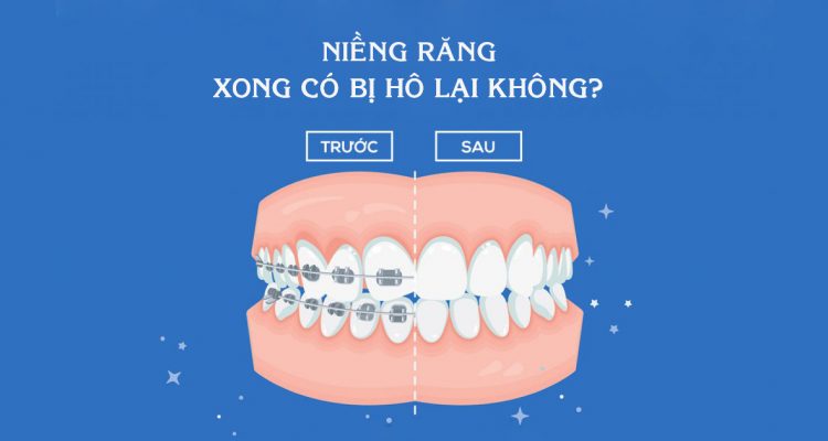 Niềng răng xong có bị hô lại không