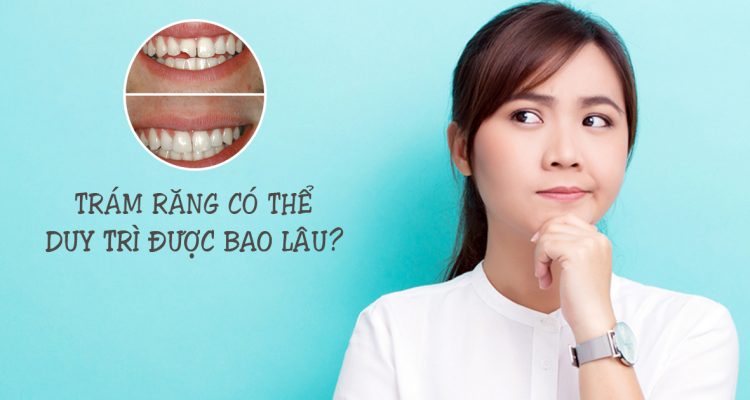 Trám răng duy trì được bao lâu