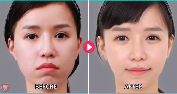 Niềng răng nha khoa linh xuân