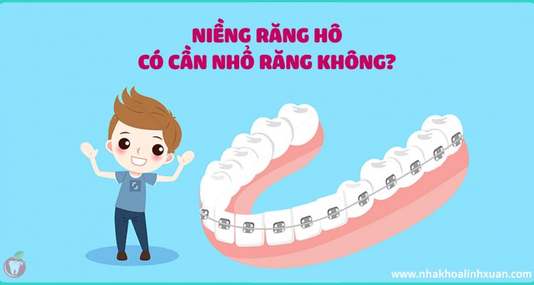 Niềng răng hô có cần nhổ răng không
