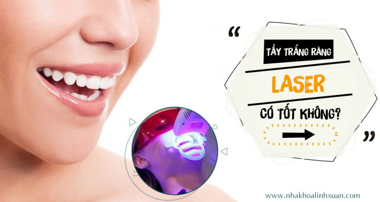 Tẩy trắng răng Laser có tốt không