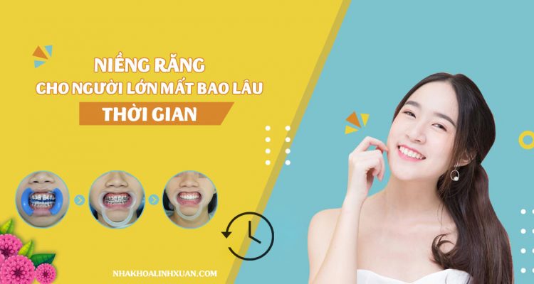Thời gian niềng răng mất bao lâu - Nha Khoa LINH XUÂN