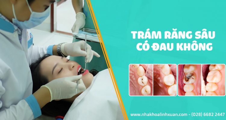 Trám răng sâu có đau không