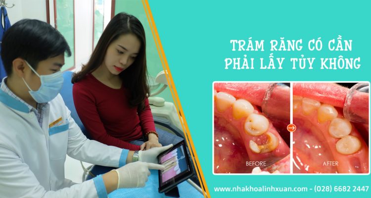 Trám răng có cần phải lấy tủy không