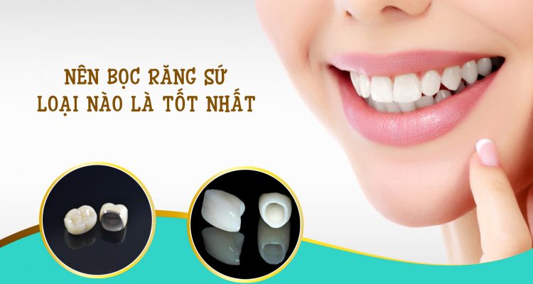 Bọc răng sứ loại nào tốt nhất