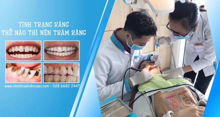 Răng như thế nào thì trám răng