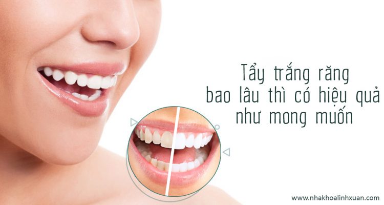 Tẩy trắng răng bao lâu thì có hiệu quả như mong muốn