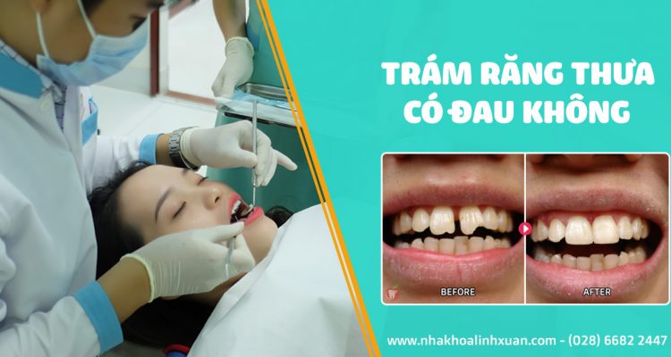 Trám răng thưa có đau không
