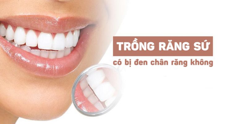 Trồng răng sứ có bị đen chân răng không