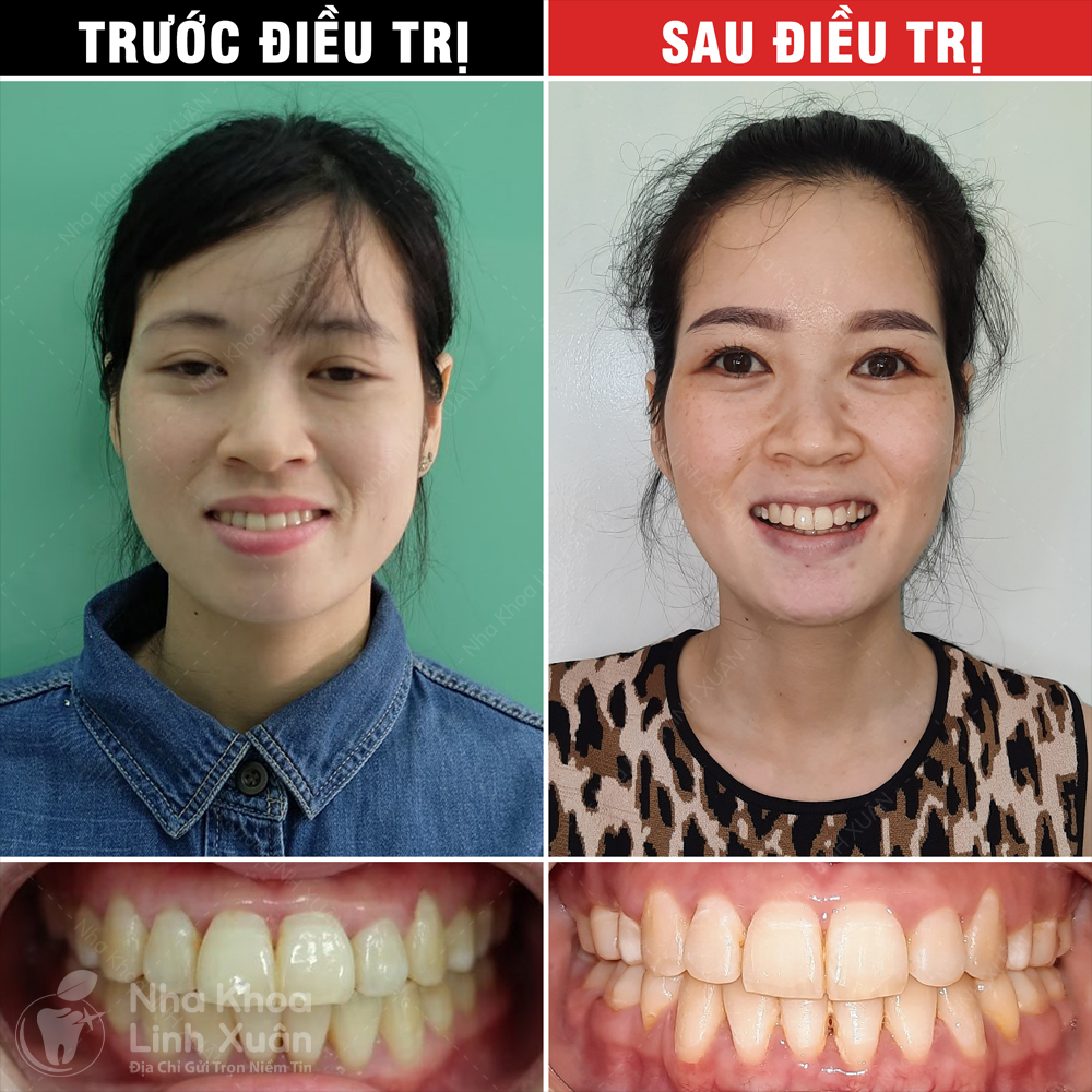 Kết quả niềng răng - Lê Thị Bình