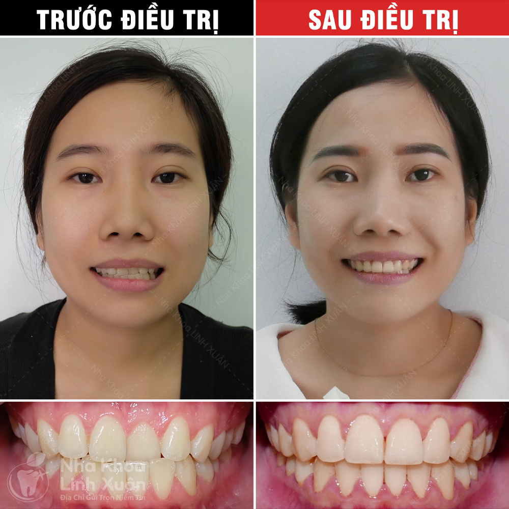 Kết quả niềng răng - Mộng Duyên