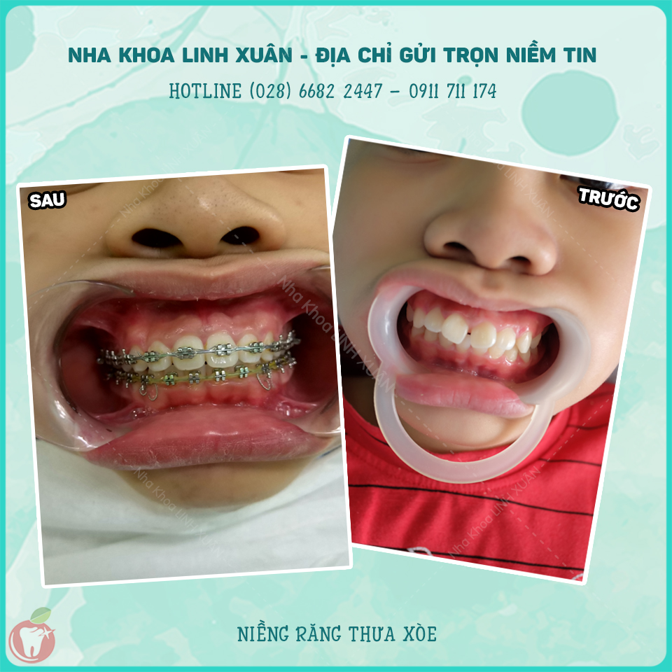 NAM KHÁNH - NHA KHOA LINH XUÂN