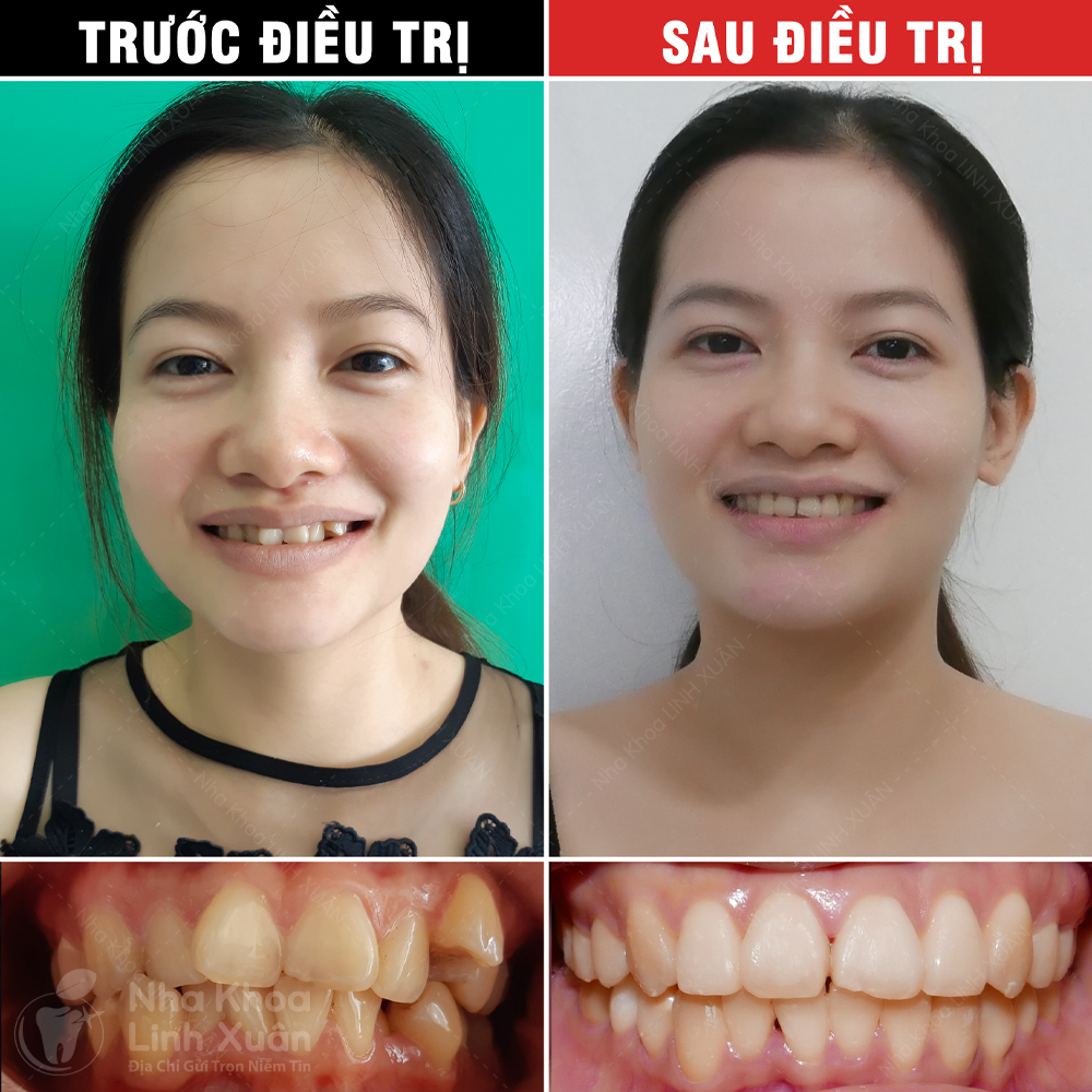Kết quả niềng răng - Thu Trinh