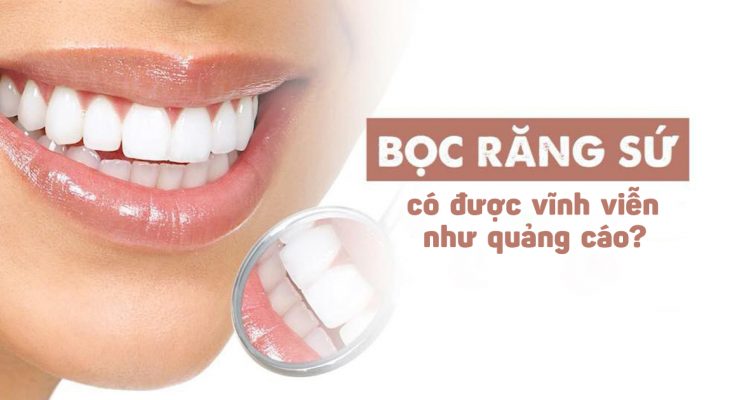 Bọc răng sứ có được vĩnh viễn như quảng cáo