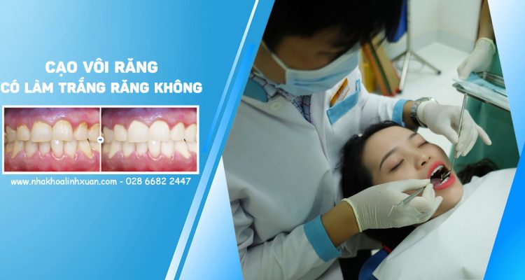 Cạo vôi răng có làm trắng răng được không