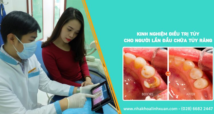 Kinh nghiệm điều trị tủy răng