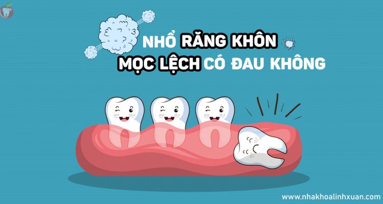 Nhổ răng khôn mọc lệch có đau không