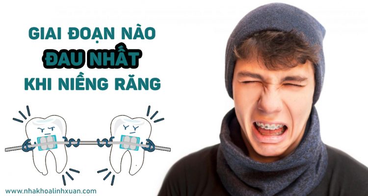 Niềng răng giai đoạn nào đau nhất