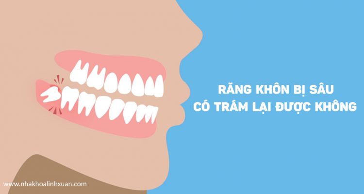 Răng khôn bị sâu có trám được không hay buộc phải nhổ