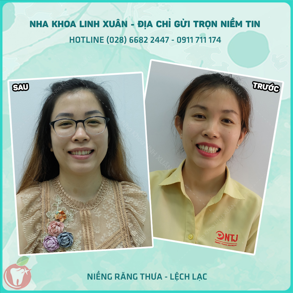 KẾT QUẢ TRƯỚC SAU NIỀNG RĂNG TẠI NHA KHOA LINH XUÂN
