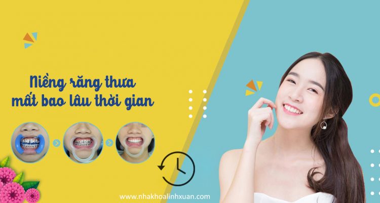 Thời gian niềng răng thưa mất bao lâu
