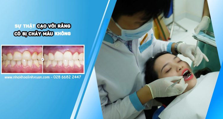 Cạo vôi răng có chảy máu không