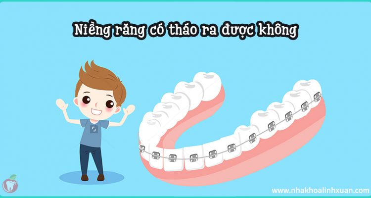 Đang niềng răng có tháo ra được không