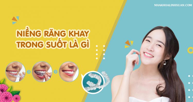 Niềng răng khay trong suốt
