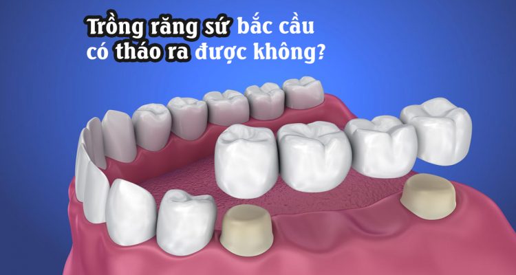 Trồng răng sứ bắc cầu có tháo ra được không