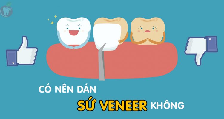 Có nên bọc răng sứ Veneer