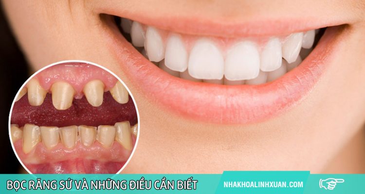 Bọc răng sứ và những điều cần biết