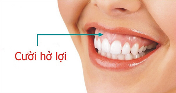 Cười Hở Lợi