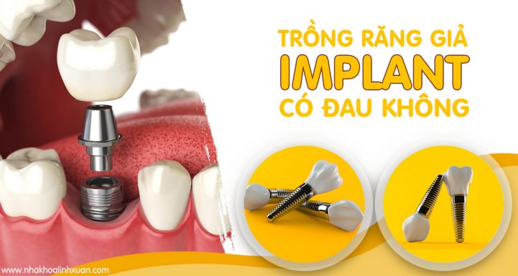 Trồng răng giả Implant có đau không