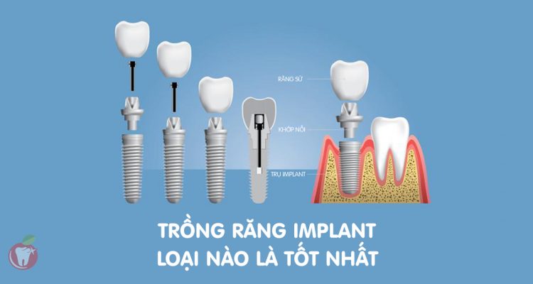 Trồng răng Implant loại nào tốt nhất