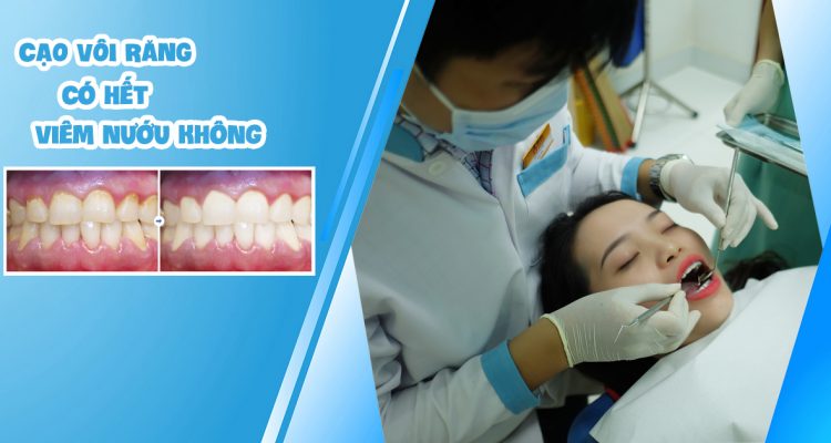 Cạo vôi răng có hết viêm nướu không